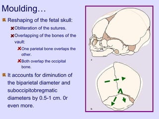 Moulding…
Reshaping of the fetal skull:
Obliteration of the sutures.
Overlapping of the bones of the
vault:
One parietal bone overlaps the
other.
Both overlap the occipital
bone.
It accounts for diminution of
the biparietal diameter and
suboccipitobregmatic
diameters by 0.5-1 cm. 0r
even more.
 