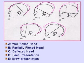 A: Well flexed Head
B: Partially Flexed Head
C: Deflexed Head
D: Face Presentation
E: Brow presentation
 
