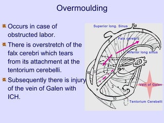 Superior long. Sinus
Inferior long sinus
Falx cerebri
Vein of Galen
Tentorium Cerebelli
Overmoulding
Occurs in case of
obstructed labor.
There is overstretch of the
falx cerebri which tears
from its attachment at the
tentorium cerebelli.
Subsequently there is injury
of the vein of Galen with
ICH.
 