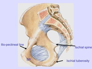 Ischial spine
Ischial tuberosity
Ilio-pectineal line
SP
 