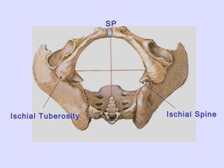 Ischial Tuberosity Ischial Spine
SP
 