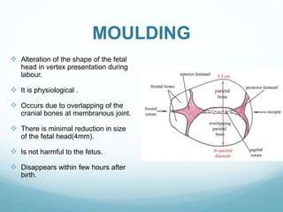 Positional Molding FETAL SKULL AND MATERNAL PELVIS (Dr. Utpala Mazumder).pptx