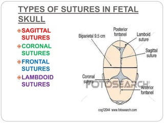 TYPES OF SUTURES IN FETAL
SKULL
SAGITTAL
SUTURES
CORONAL
SUTURES
FRONTAL
SUTURES
LAMBDOID
SUTURES
 