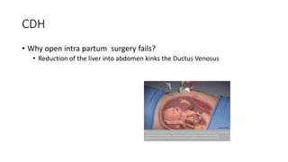 CDH
• Why open intra partum surgery fails?
• Reduction of the liver into abdomen kinks the Ductus Venosus
 
