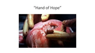 “Hand of Hope”
 