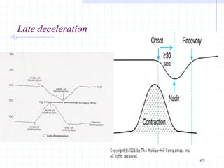 Late deceleration
62
 