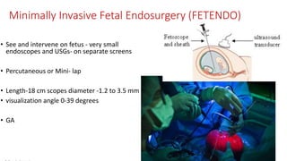 Minimally Invasive Fetal Endosurgery (FETENDO)
• See and intervene on fetus - very small
endoscopes and USGs- on separate screens
• Percutaneous or Mini- lap
• Length-18 cm scopes diameter -1.2 to 3.5 mm
• visualization angle 0-39 degrees
• GA
 