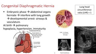 Congenital Diaphragmatic Hernia
 Embryonic phase  abdominal organs
herniate  interfere with lung growth
 developmental arrest- airways &
vasculature.
At birth  pulmonary
hypoplasia, hypertension, immaturity
Lung head
circumference
ratio (LHR) < 1
 