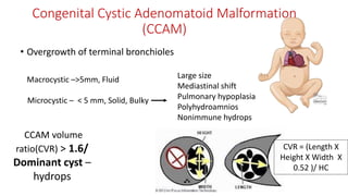Congenital Cystic Adenomatoid Malformation
(CCAM)
• Overgrowth of terminal bronchioles
Macrocystic –>5mm, Fluid
Microcystic – < 5 mm, Solid, Bulky
Large size
Mediastinal shift
Pulmonary hypoplasia
Polyhydroamnios
Nonimmune hydrops
CVR = (Length X
Height X Width X
0.52 )/ HC
CCAM volume
ratio(CVR) > 1.6/
Dominant cyst –
hydrops
 