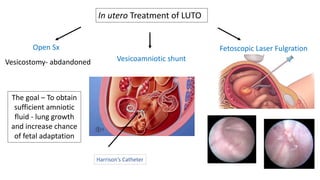 Open Sx
The goal – To obtain
sufficient amniotic
fluid - lung growth
and increase chance
of fetal adaptation
Vesicostomy- abdandoned Vesicoamniotic shunt
Fetoscopic Laser Fulgration
In utero Treatment of LUTO
Harrison’s Catheter
 