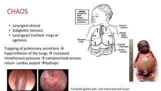 CHAOS
Complete glottic web and interarytenoid fusion
• Laryngeal atresia
• Subglottic stenosis
• Laryngeal/ tracheal -rings or
agenesis
Trapping of pulmonary secretions 
hyperinflation of the lungs  increased
intrathoracic pressure  compromised venous
return cardiac output hydrops
 