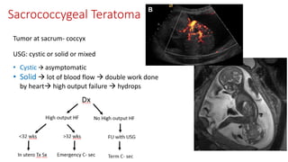 Sacrococcygeal Teratoma
High output HF
Tumor at sacrum- coccyx
USG: cystic or solid or mixed
• Cystic  asymptomatic
• Solid  lot of blood flow  double work done
by heart high output failure  hydrops
Dx
No High output HF
<32 wks >32 wks
In utero Tx Sx Emergency C- sec
FU with USG
Term C- sec
 