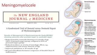 Meningomyelocele
 