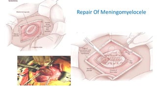 Treatment Options
Repair Of Meningomyelocele
 
