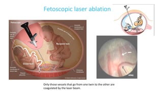 Only those vessels that go from one twin to the other are
coagulated by the laser beam.
Fetoscopic laser ablation
 