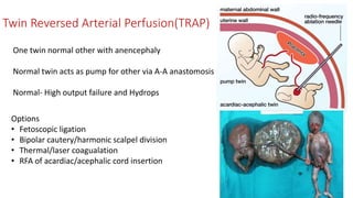 Twin Reversed Arterial Perfusion(TRAP)
One twin normal other with anencephaly
Normal twin acts as pump for other via A-A anastomosis
Normal- High output failure and Hydrops
Options
• Fetoscopic ligation
• Bipolar cautery/harmonic scalpel division
• Thermal/laser coagualation
• RFA of acardiac/acephalic cord insertion
 