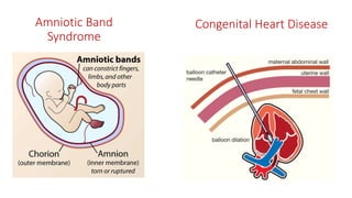 Amniotic Band
Syndrome
Congenital Heart Disease
 