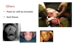 Others
• Plastic Sx- cleft lip and palate
• Neck Masses
 