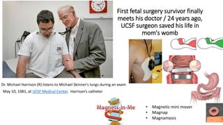 First fetal surgery survivor finally
meets his doctor / 24 years ago,
UCSF surgeon saved his life in
mom's womb
Dr. Michael Harrison (R) listens to Michael Skinner's lungs during an exam
May 10, 1981, at UCSF Medical Center. Harrison’s catheter
• Magnetic mini mover
• Magnap
• Magnamosis
 