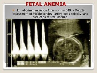 FETAL ANEMIA
 -Rh allo-immunization & parvovirus B19 - Doppler
assessment of Middle cerebral artery peak velocity and
prediction of fetal anemia.
 