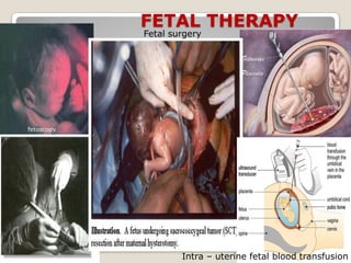 FETAL THERAPY
fetoscopy
Intra – uterine fetal blood transfusion
Fetal surgery
 