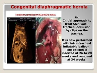 Congenital diaphragmatic hernia
Rx
Initial approach to
treat CDH was -
tracheal occlusion
by clips on the
trachea.
It is now performed
with intra-tracheal
inflatable balloon.
The balloon is
inserted at 26 to 28
weeks and removed
at 34 weeks.
 