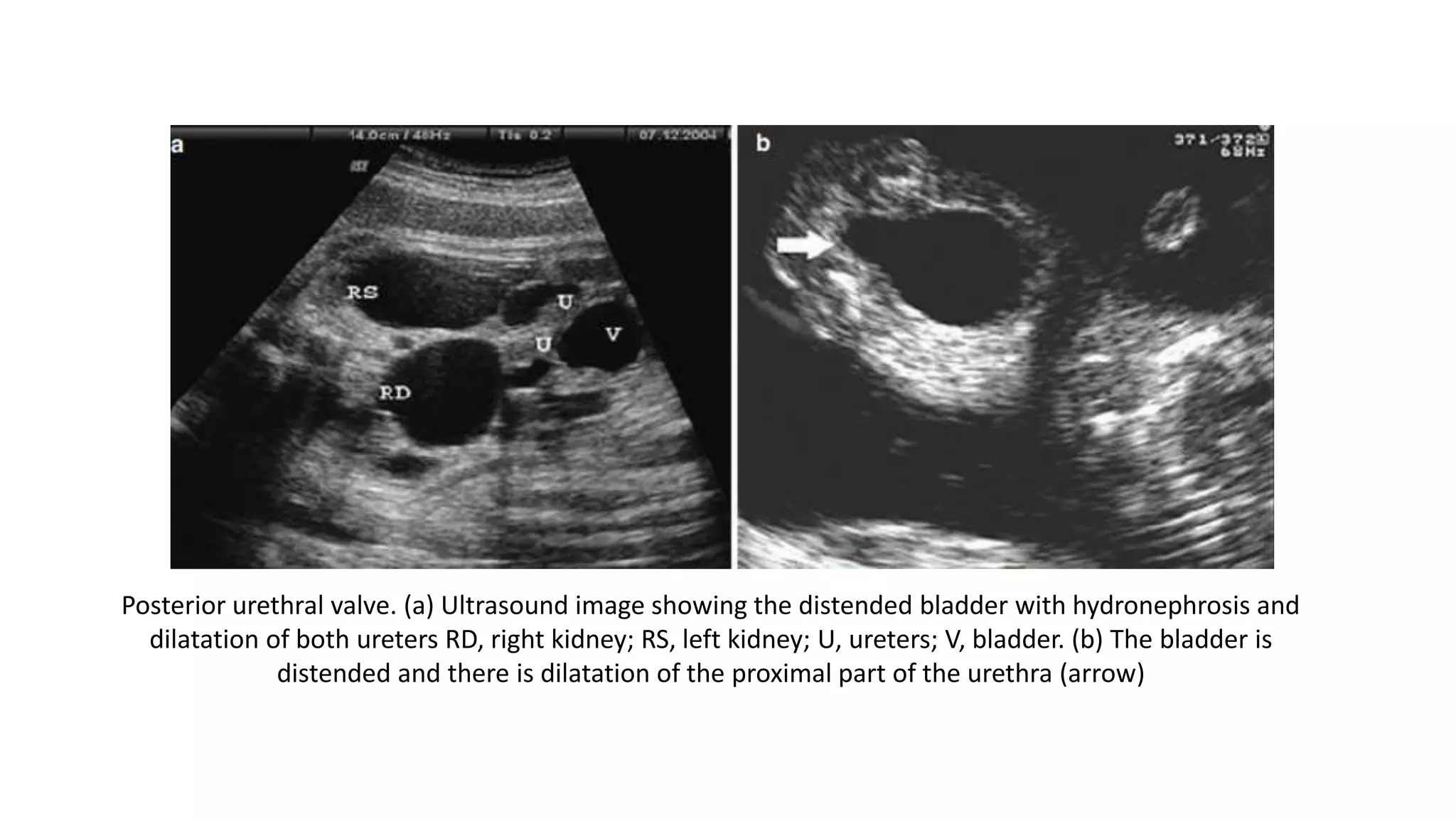 Fetal urinary tract ultrasound | PPT
