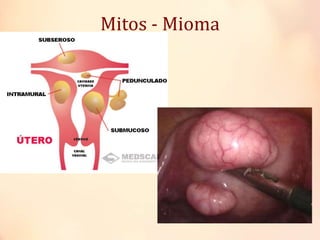 Mitos - Mioma
 