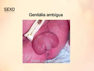 Genitália ambígua
 