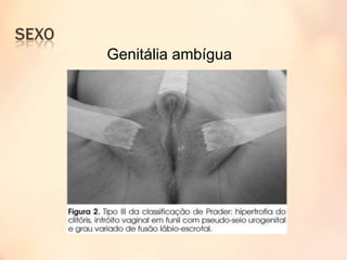 Genitália ambígua
 