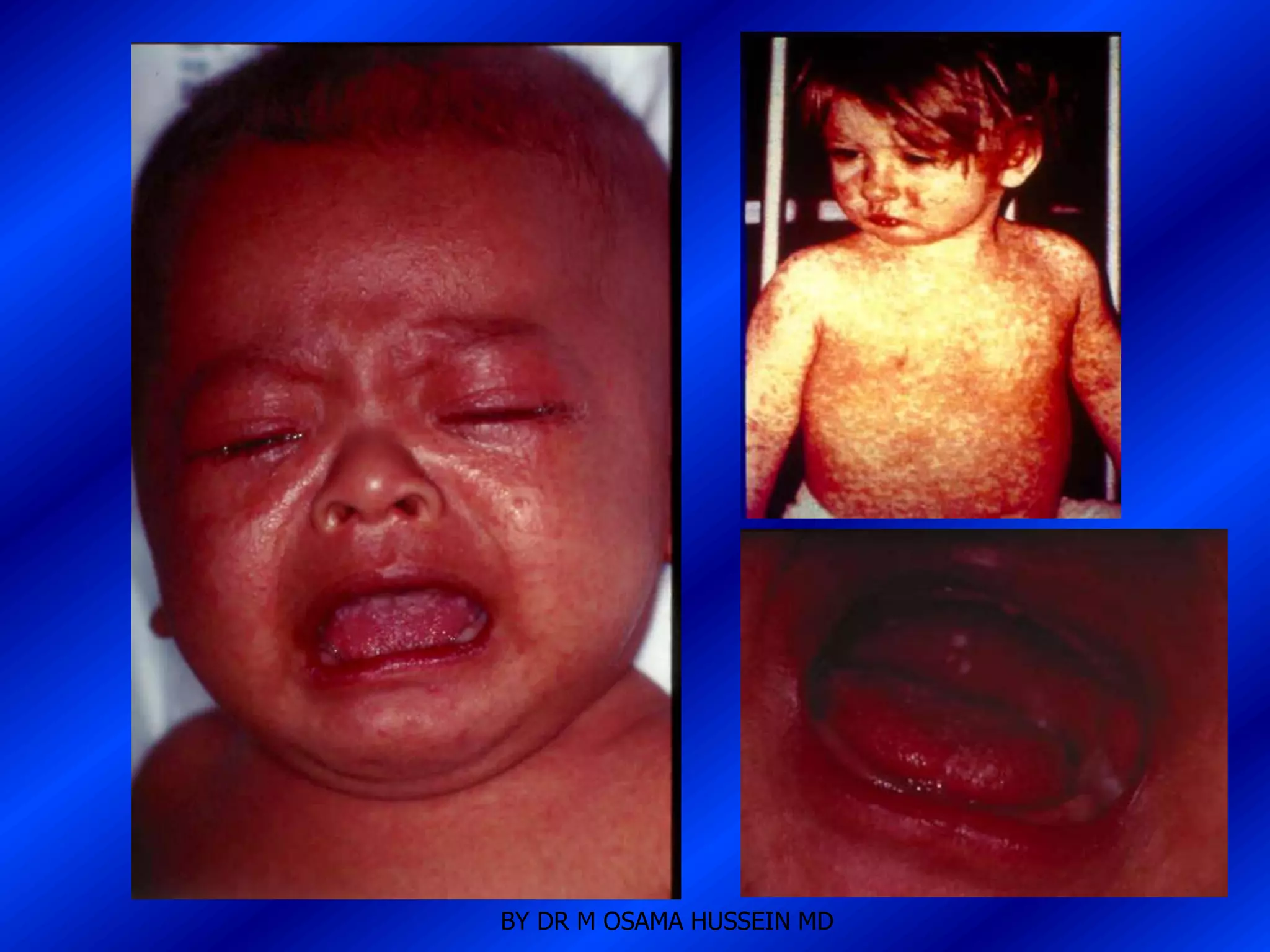 BY DR M OSAMA HUSSEIN MD
 