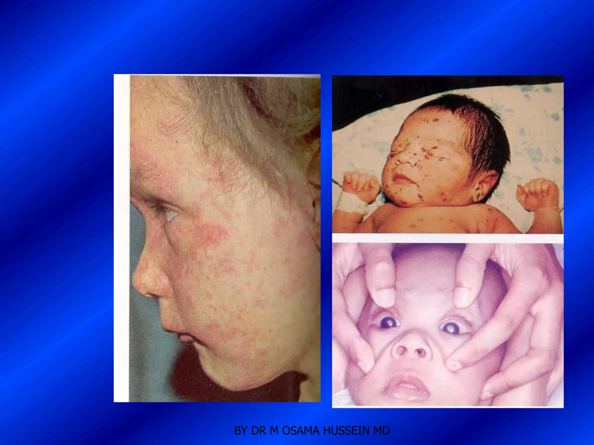 BY DR M OSAMA HUSSEIN MD
 