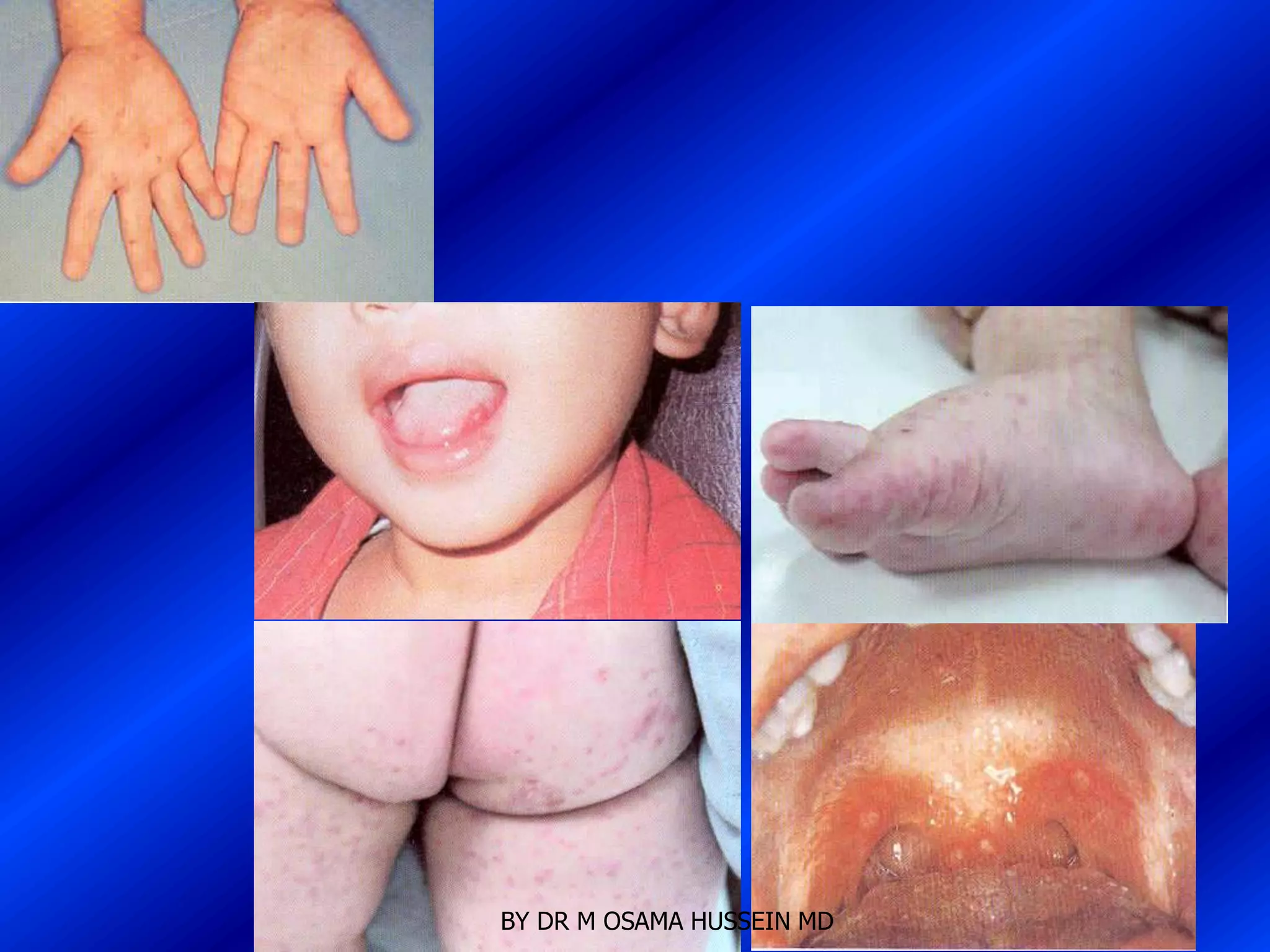 HFMD




       BY DR M OSAMA HUSSEIN MD
 