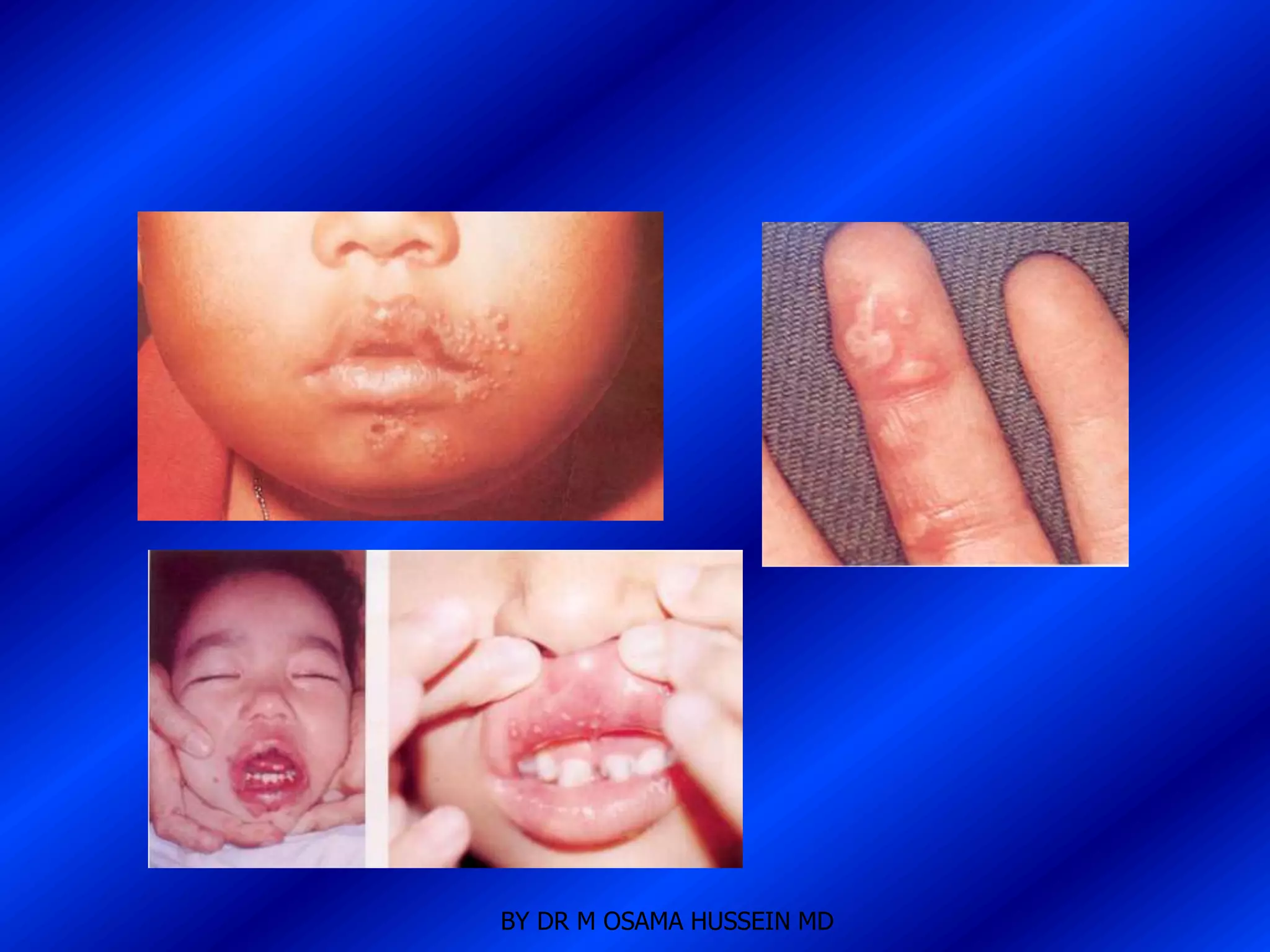 BY DR M OSAMA HUSSEIN MD
 