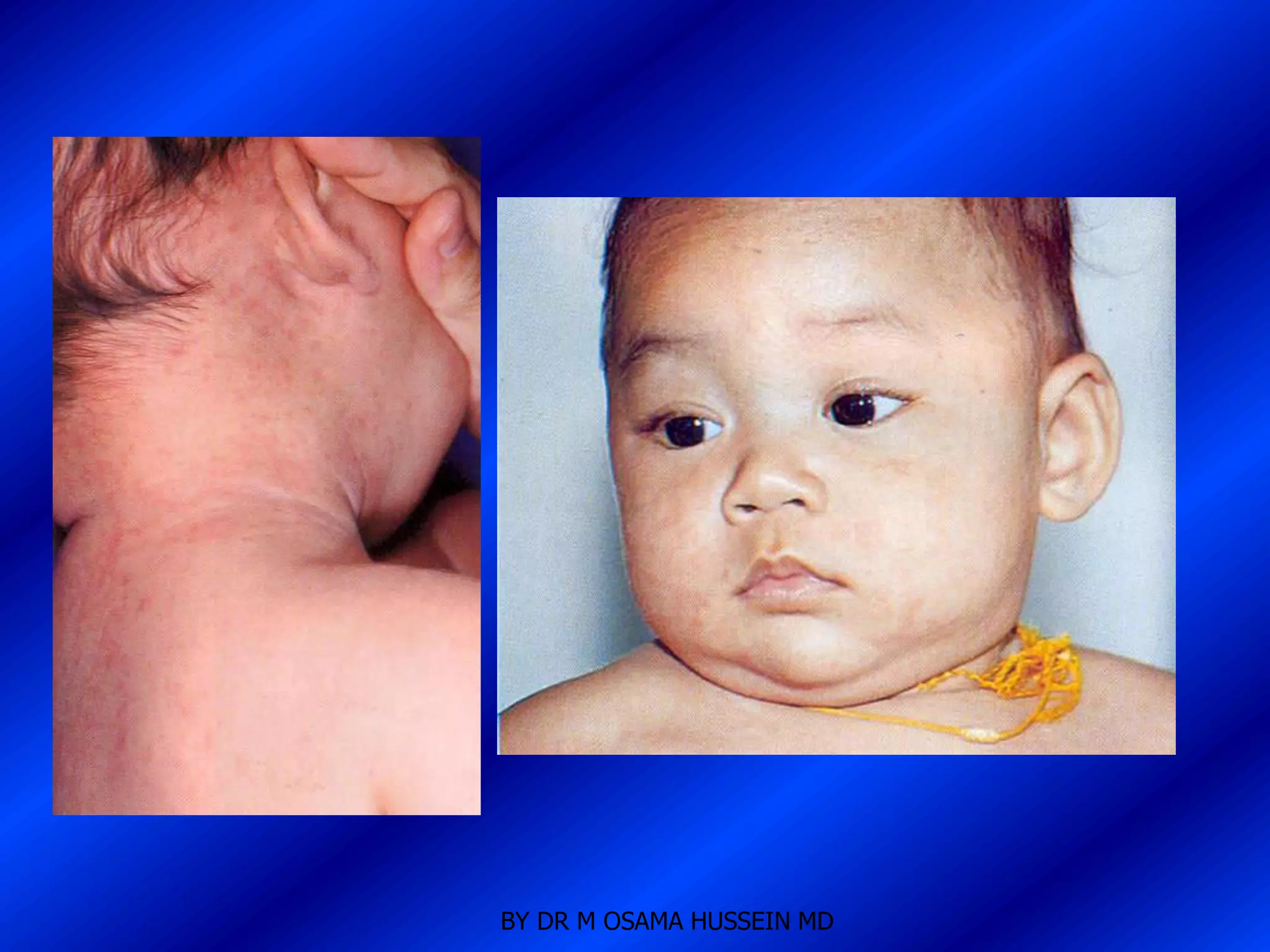 BY DR M OSAMA HUSSEIN MD
 