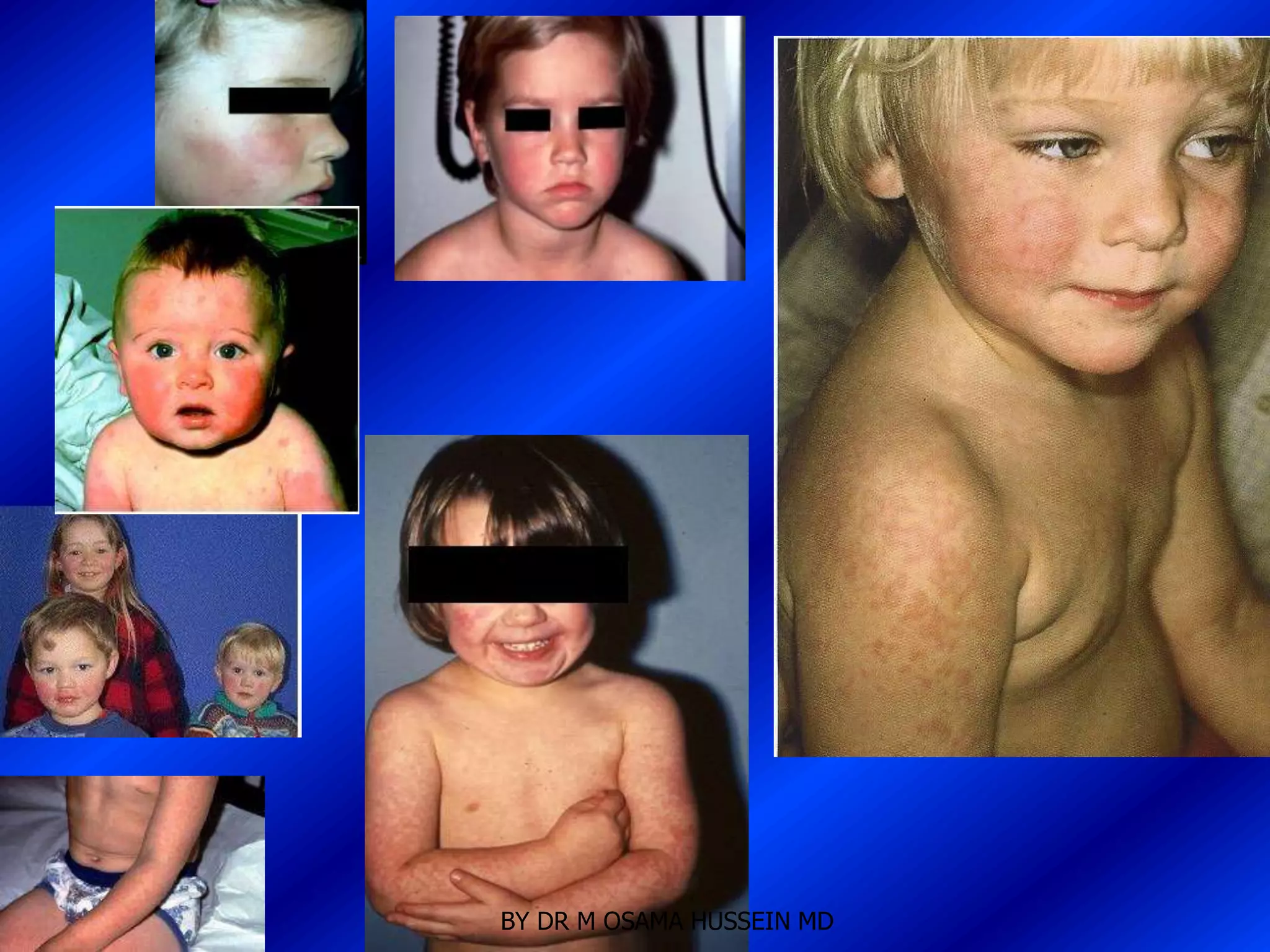 BY DR M OSAMA HUSSEIN MD
 