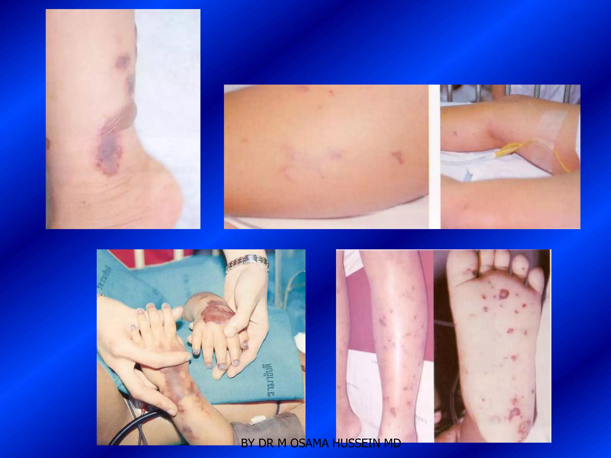 BY DR M OSAMA HUSSEIN MD
 