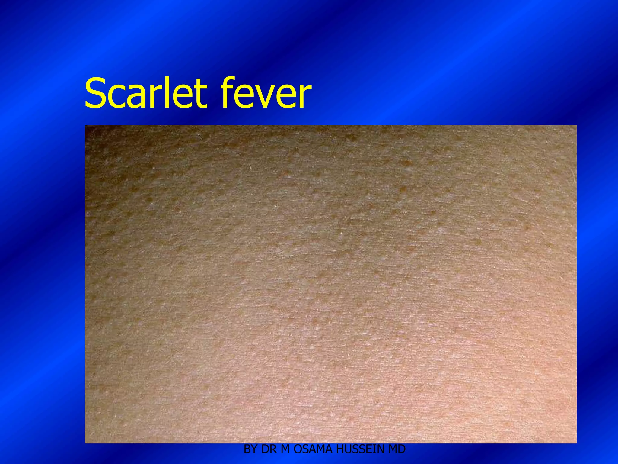 Scarlet fever




         BY DR M OSAMA HUSSEIN MD
 
