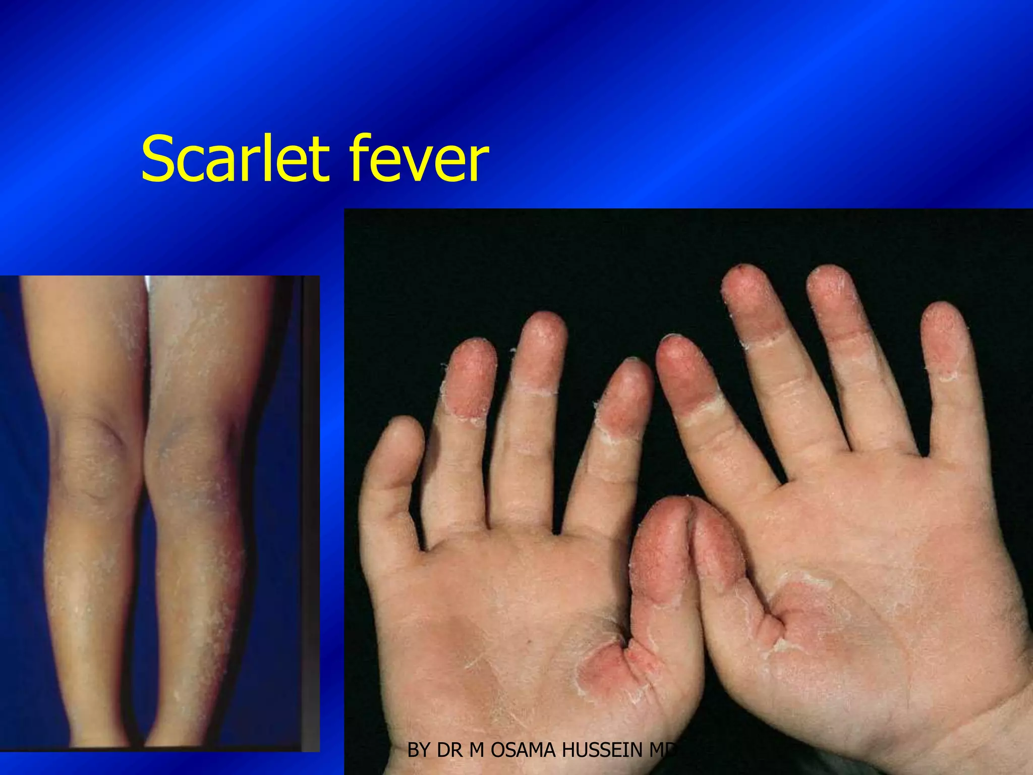 Scarlet fever




         BY DR M OSAMA HUSSEIN MD
 