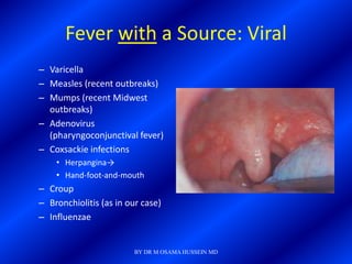 Fever with a Source: Viral
– Varicella
– Measles (recent outbreaks)
– Mumps (recent Midwest
  outbreaks)
– Adenovirus
  (pharyngoconjunctival fever)
– Coxsackie infections
    • Herpangina→
    • Hand-foot-and-mouth
– Croup
– Bronchiolitis (as in our case)
– Influenzae


                         BY DR M OSAMA HUSSEIN MD
 
