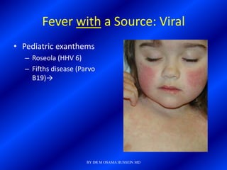 Fever with a Source: Viral
• Pediatric exanthems
  – Roseola (HHV 6)
  – Fifths disease (Parvo
    B19)→




                      BY DR M OSAMA HUSSEIN MD
 