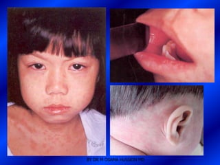 BY DR M OSAMA HUSSEIN MD
 