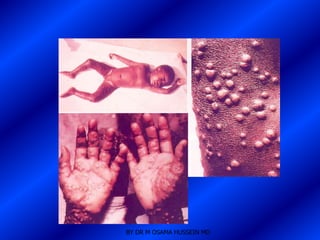 BY DR M OSAMA HUSSEIN MD
 