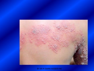 BY DR M OSAMA HUSSEIN MD
 