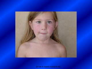 BY DR M OSAMA HUSSEIN MD
 