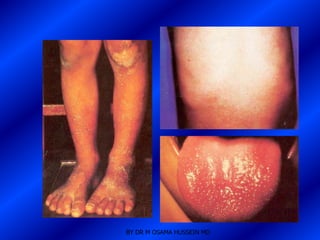 BY DR M OSAMA HUSSEIN MD
 