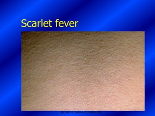 Scarlet fever




         BY DR M OSAMA HUSSEIN MD
 