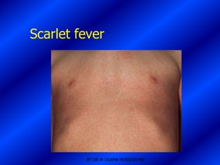 Scarlet fever




         BY DR M OSAMA HUSSEIN MD
 