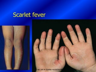 Scarlet fever




         BY DR M OSAMA HUSSEIN MD
 
