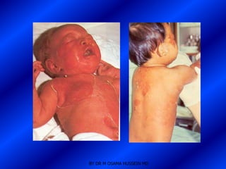 BY DR M OSAMA HUSSEIN MD
 